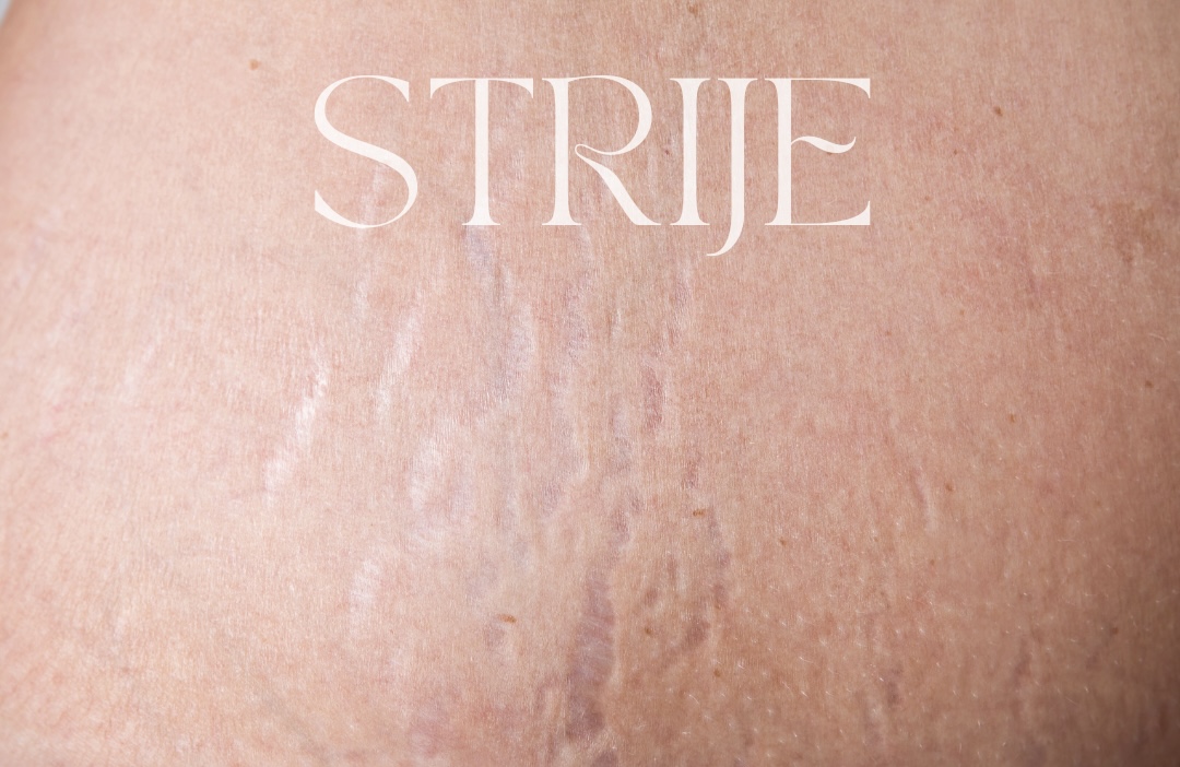 Strije — lasersko liječenje